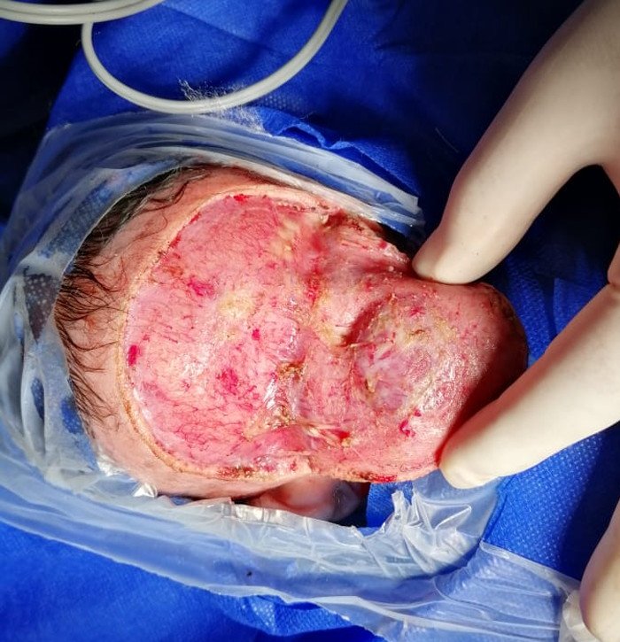 hemangioma-congenito-tratamiento-cirugia