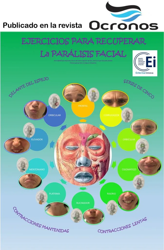 infografia-paralisis-facial