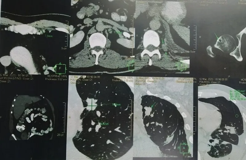 9-TAC-torax-abdomen-pelvis-caso-clinico-adenocarcinoma