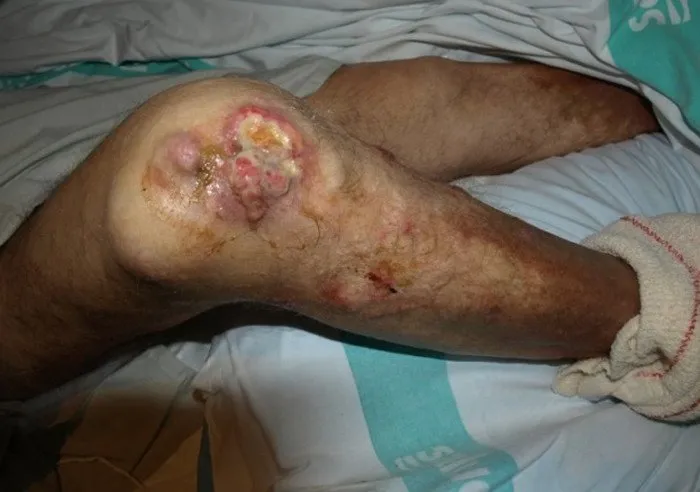 4-tumor-sarcoma-partes-blandas-miembro-inferior