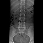 1-enfermedad-pott-tuberculosis-columna-vertebral-radiogradia-columna