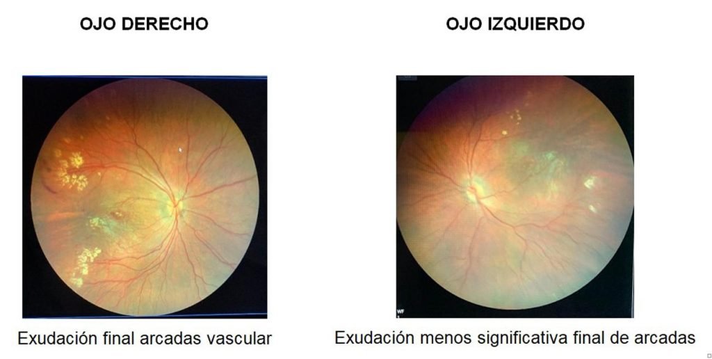 neonato-vitreorretinopatia-exudativa-familiar.jpg